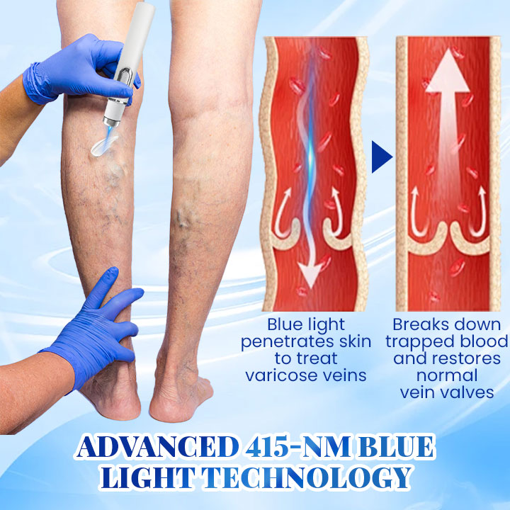 Biancat™ Blue Light Therapy Set for Varicose Veins